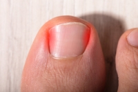 Medical Treatment May Be Needed for Ingrown Toenails