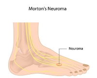 Morton’s Neuroma and the Ball of the Foot