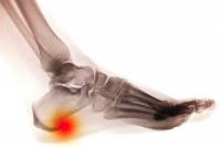 Heel Spurs May Develop in Different Parts of the Foot