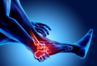 Types and Alleviation Strategies for Foot Arthritis